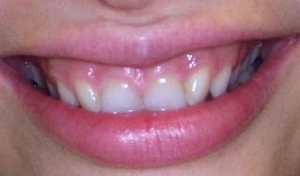 gingival