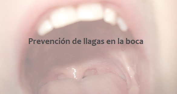 Alimentación Para Prevención De Llagas En La Boca Dental Asensio Tu 4673